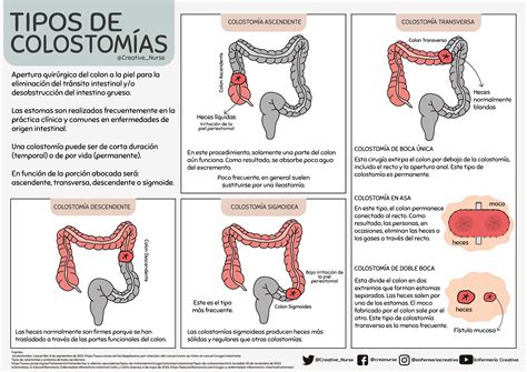 sistema de colostomía.